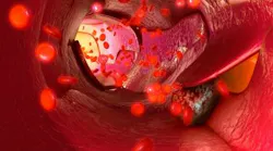 Content Dam Bow En Articles 2017 08 Spaser Detects And Destroys Circulating Tumor Cells To Prevent Cancer Metastases Leftcolumn Article Thumbnailimage File