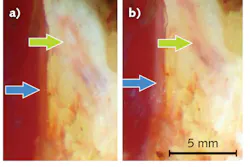 In a demonstration of the on-off switch effect of collimated polarized light imaging (CPLi), the blue arrow highlights a vertical structure (a), which appears whiter after rotating the polarizers (b). The opposite occurs at the oblique structure (green arrow) indicating nerve tissue. The CPLi stereo microscope that produced these images features a pair of adjustable collimation lenses that refract the light of 3 W LEDs on either side of the unit. It also provides a linear polarizer (on the outer rim of a polarization disk) that aligns perpendicularly to an inner linear polarizer.