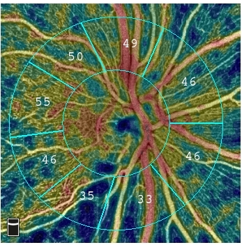 Content Dam Bow Article 2018 6 Disc Vessel Density Inf Rnfl Loss Angioanalytics