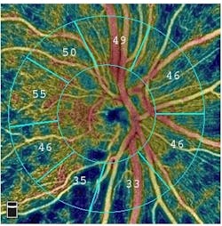 Content Dam Bow Article 2018 6 Disc Vessel Density Inf Rnfl Loss Angioanalytics Content Dam Bow Article 2018 6 Disc Vessel Density Inf Rnfl Loss Angioanalytics