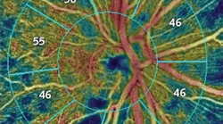 Technology newly approved by the FDA provides quantitative measurement of blood-vessel density in the optic disc; this image, taken from a patient with glaucoma, shows loss of retinal nerve fiber.