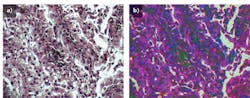FIGURE 3. A raw H&E stained image of lung cancer tissue collected with the HinaLea hyperspectral microscope system under 20X magnification with quartz tungsten halogen lamp illumination (a) is compared to the classified image using a band selection approach with a priori information (b). FIGURE 3. A raw H&E stained image of lung cancer tissue collected with the HinaLea hyperspectral microscope system under 20X magnification with quartz tungsten halogen lamp illumination (a) is compared to the classified image using a band selection approach with a priori information (b).