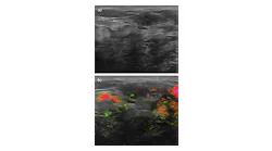Masses initially categorized as BI-RADS 4a and suspicious on ultrasound because of irregular shape and microlobulation (a) were ultimately downgraded as nonsuspicious (BI-RADS 3) with OA/US technology (b) because of benign-appearing internal and capsular vessels.