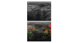 Masses initially categorized as BI-RADS 4a and suspicious on ultrasound because of irregular shape and microlobulation (a) were ultimately downgraded as nonsuspicious (BI-RADS 3) with OA/US technology (b) because of benign-appearing internal and capsular vessels.