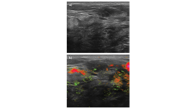 Masses initially categorized as BI-RADS 4a and suspicious on ultrasound because of irregular shape and microlobulation (a) were ultimately downgraded as nonsuspicious (BI-RADS 3) with OA/US technology (b) because of benign-appearing internal and capsular vessels.