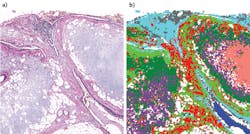 A nonmalignant lung tissue tumor section stained with H&E (a) depends on the pathologist's eyes and memory, whereas the corresponding IR spectral image (b), based on the analysis of spectral similarity only and no input from a pathologist, is quantifiable and can be analyzed with complete objectivity. A nonmalignant lung tissue tumor section stained with H&E (a) depends on the pathologist's eyes and memory, whereas the corresponding IR spectral image (b), based on the analysis of spectral similarity only and no input from a pathologist, is quantifiable and can be analyzed with complete objectivity.