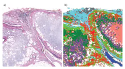 A nonmalignant lung tissue tumor section stained with H&E (a) depends on the pathologist's eyes and memory, whereas the corresponding IR spectral image (b), based on the analysis of spectral similarity only and no input from a pathologist, is quantifiable and can be analyzed with complete objectivity.