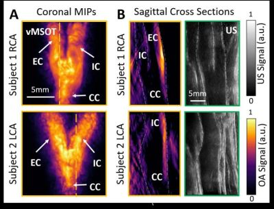 Content Dam Bow Online Articles 2019 02 Optical Imaging Cardiovascular Risk