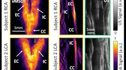 Content Dam Bow Online Articles 2019 02 Optical Imaging Cardiovascular Risk