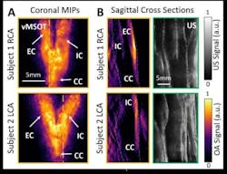Content Dam Bow Online Articles 2019 02 Optical Imaging Cardiovascular Risk Content Dam Bow Online Articles 2019 02 Optical Imaging Cardiovascular Risk
