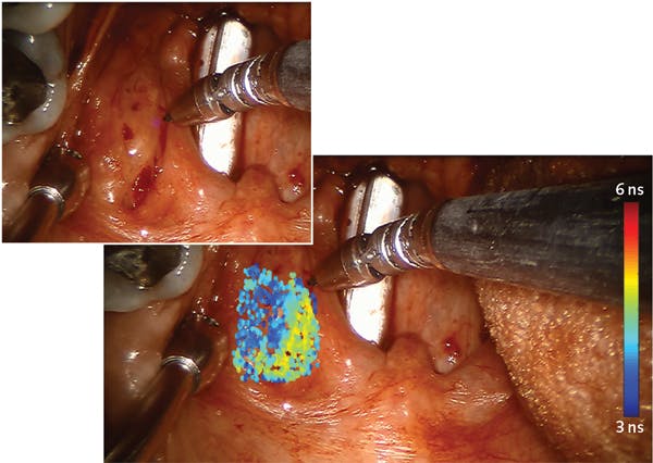 During transoral robotic surgery (TORS; inset), the da Vinci system overlays conventional white-light endoscopy imagery with multispectral time-resolved fluorescence spectroscopy (ms-TRFS)-derived data on the surgeon&rsquo;s console display. The 445 nm aiming beam, which identifies the location being assessed by ms-TRFS (inset), is visible at the probe&rsquo;s distal end.