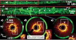 FIGURE 2. In vivo human peripheral airways imaging is shown, including an autofluorescence imaging dataset (a), a magnified area enclosed by the red box (b), and OCT radial cross-sections corresponding to the dashed lines showing large vessels (c-e). FIGURE 2. In vivo human peripheral airways imaging is shown, including an autofluorescence imaging dataset (a), a magnified area enclosed by the red box (b), and OCT radial cross-sections corresponding to the dashed lines showing large vessels (c-e).