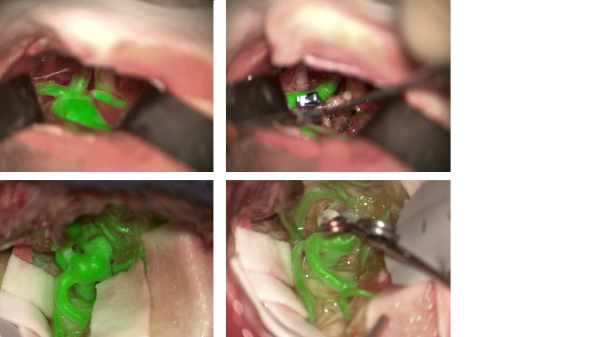 The Leica GLOW800 AR surgical microscope accessory depicts blood flow and related tissue perfusion, which can be useful for the placement and monitoring of an aneurysm clip.