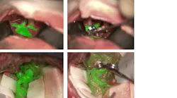 The Leica GLOW800 AR surgical microscope accessory depicts blood flow and related tissue perfusion, which can be useful for the placement and monitoring of an aneurysm clip.