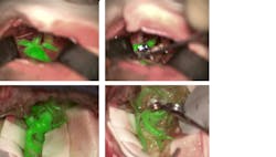 The Leica GLOW800 AR surgical microscope accessory depicts blood flow and related tissue perfusion, which can be useful for the placement and monitoring of an aneurysm clip. The Leica GLOW800 AR surgical microscope accessory depicts blood flow and related tissue perfusion, which can be useful for the placement and monitoring of an aneurysm clip.