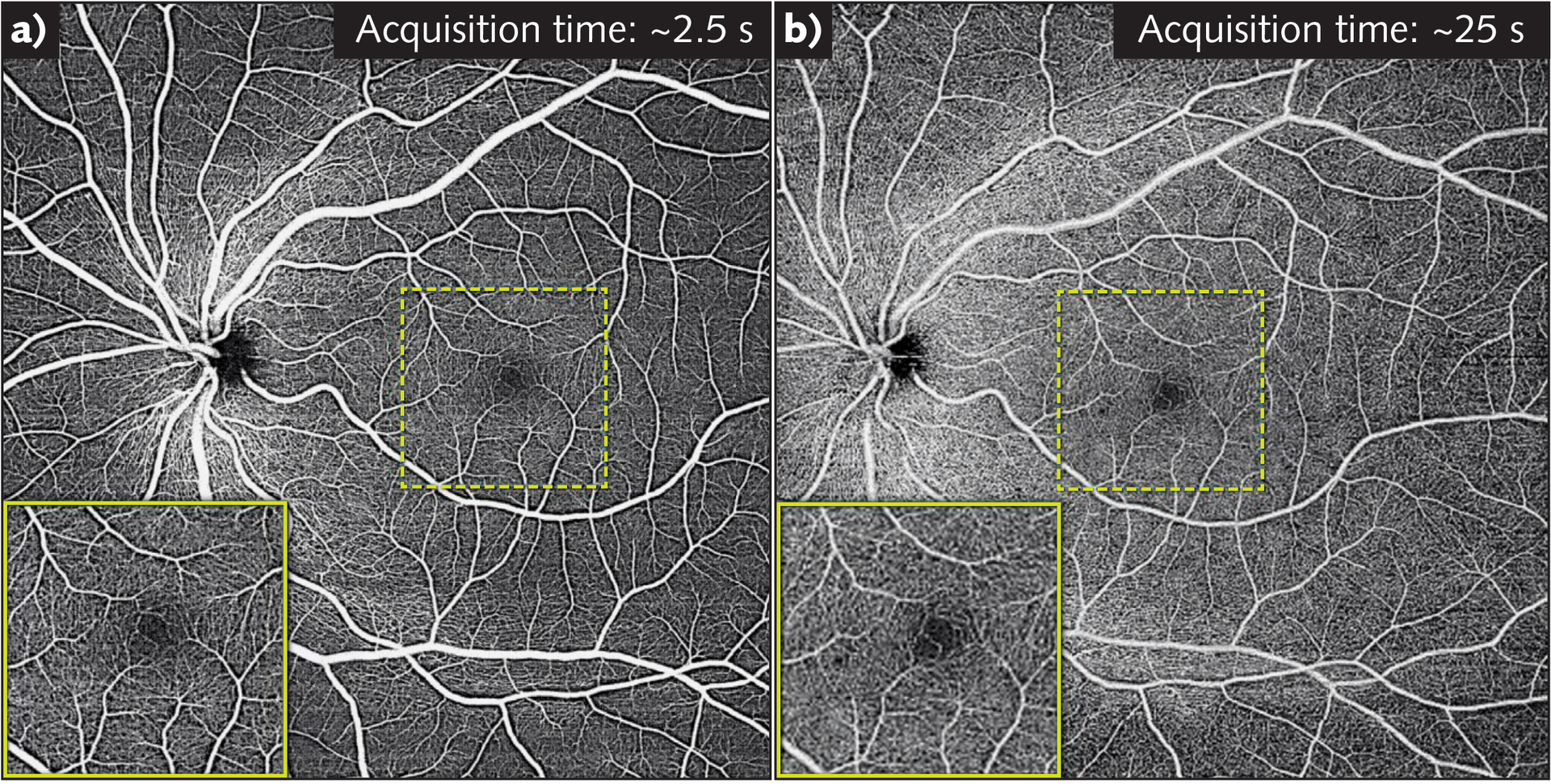 FIGURE 1. SS-OCT at megahertz speed is not as futuristic as it may seem: The OCTA 12 &times; 12 mm FOV scan (a) was captured in less than 2.5 s (at 1.7 million A-scans/second) and delivers the same quality as the image in (b), which took 25 s to scan using a 100 kHz system.
