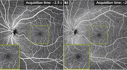 FIGURE 1. SS-OCT at megahertz speed is not as futuristic as it may seem: The OCTA 12 × 12 mm FOV scan (a) was captured in less than 2.5 s (at 1.7 million A-scans/second) and delivers the same quality as the image in (b), which took 25 s to scan using a 100 kHz system.