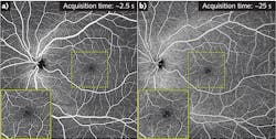 FIGURE 1. SS-OCT at megahertz speed is not as futuristic as it may seem: The OCTA 12 × 12 mm FOV scan (a) was captured in less than 2.5 s (at 1.7 million A-scans/second) and delivers the same quality as the image in (b), which took 25 s to scan using a 100 kHz system. FIGURE 1. SS-OCT at megahertz speed is not as futuristic as it may seem: The OCTA 12 × 12 mm FOV scan (a) was captured in less than 2.5 s (at 1.7 million A-scans/second) and delivers the same quality as the image in (b), which took 25 s to scan using a 100 kHz system.