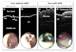 FIGURE 4. PhotoniCare is bringing to market OCT&rsquo;s ability to easily differentiate cases with and without middle ear effusion (MEE).