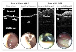 FIGURE 4. PhotoniCare is bringing to market OCT’s ability to easily differentiate cases with and without middle ear effusion (MEE). FIGURE 4. PhotoniCare is bringing to market OCT’s ability to easily differentiate cases with and without middle ear effusion (MEE).