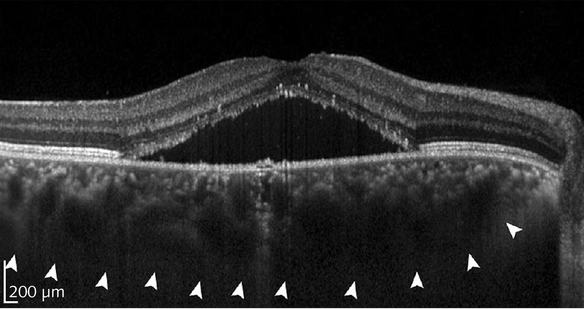 OCT images, such as this one displaying signs of chorioretinopathy, contain anatomical insights into abnormal conditions; artificial intelligence (AI) can help mine clinical images to assist in diagnosis.