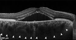 OCT images, such as this one displaying signs of chorioretinopathy, contain anatomical insights into abnormal conditions; artificial intelligence (AI) can help mine clinical images to assist in diagnosis. OCT images, such as this one displaying signs of chorioretinopathy, contain anatomical insights into abnormal conditions; artificial intelligence (AI) can help mine clinical images to assist in diagnosis.