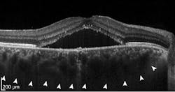 OCT images, such as this one displaying signs of chorioretinopathy, contain anatomical insights into abnormal conditions; artificial intelligence (AI) can help mine clinical images to assist in diagnosis. OCT images, such as this one displaying signs of chorioretinopathy, contain anatomical insights into abnormal conditions; artificial intelligence (AI) can help mine clinical images to assist in diagnosis.