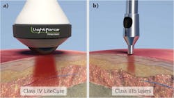 FIGURE 3. Comparison of laser depth penetration for a high-power class IV diode laser (a) and a lower power class IIIb diode laser (b). FIGURE 3. Comparison of laser depth penetration for a high-power class IV diode laser (a) and a lower power class IIIb diode laser (b).