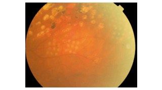 FIGURE 1. This picture of a human eye shows different sets of laser spots obtained with standard parameters of power and photocoagulation time using a 577 nm fiber laser.