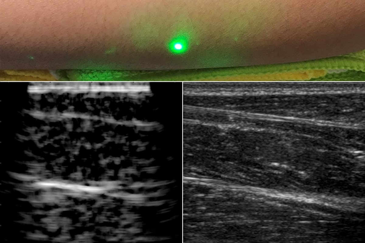 The MIT laser ultrasound system uses two separate lasers to generate an acoustic signal and detect consequent skin vibrations, which can be reconstructed to generate a tissue image (lower left) showing the same features as conventional ultrasound (lower right).
