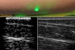 The MIT laser ultrasound system uses two separate lasers to generate an acoustic signal and detect consequent skin vibrations, which can be reconstructed to generate a tissue image (lower left) showing the same features as conventional ultrasound (lower right). The MIT laser ultrasound system uses two separate lasers to generate an acoustic signal and detect consequent skin vibrations, which can be reconstructed to generate a tissue image (lower left) showing the same features as conventional ultrasound (lower right).