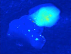 Parathyroid tissue (upper right) autofluoresces under near-IR light at significantly greater intensity than does any other tissue in the neck. Parathyroid tissue (upper right) autofluoresces under near-IR light at significantly greater intensity than does any other tissue in the neck.