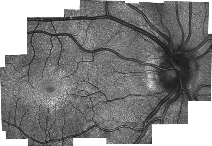 A retinal image generated by the SLO/OCT probe reveals the eye's photoreceptors (cones), which were not able to be seen with previous handheld technologies, as miniature white dots. The concentrated circular area is the fovea. It is believed that, as the eye matures, photoreceptors migrate to this area and populate it densely.