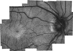 A retinal image generated by the SLO/OCT probe reveals the eye's photoreceptors (cones), which were not able to be seen with previous handheld technologies, as miniature white dots. The concentrated circular area is the fovea. It is believed that, as the eye matures, photoreceptors migrate to this area and populate it densely. A retinal image generated by the SLO/OCT probe reveals the eye's photoreceptors (cones), which were not able to be seen with previous handheld technologies, as miniature white dots. The concentrated circular area is the fovea. It is believed that, as the eye matures, photoreceptors migrate to this area and populate it densely.