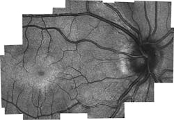 A retinal image generated by the SLO/OCT probe reveals the eye&apos;s photoreceptors (cones), which were not able to be seen with previous handheld technologies, as miniature white dots. The concentrated circular area is the fovea. It is believed that, as the eye matures, photoreceptors migrate to this area and populate it densely.