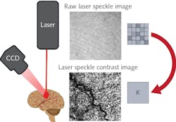 FIGURE 1. Schematic representation of a LSCI, showing the typical illumination, imaging, and image-processing methodologies. FIGURE 1. Schematic representation of a LSCI, showing the typical illumination, imaging, and image-processing methodologies.