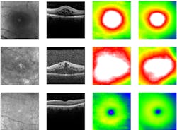 Retinal Thicknes Prediction 5fb57d61e4c41 Retinal Thicknes Prediction 5fb57d61e4c41