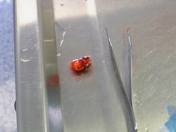 The fibrosarcoma mass, which measures 3 cm in diameter, was removed from Frank the goldfish. The fibrosarcoma mass, which measures 3 cm in diameter, was removed from Frank the goldfish.