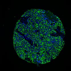 FIGURE 3. AQUAnalysis software can combine a range of molecular structures, such as the cytokeratin proteins (green) in the cytoplasm and DNA (blue) in the nucleus labeled here. FIGURE 3. AQUAnalysis software can combine a range of molecular structures, such as the cytokeratin proteins (green) in the cytoplasm and DNA (blue) in the nucleus labeled here.
