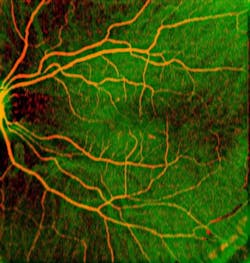 FIGURE 1. Angiographic OCT fundus image of human retina obtained by swept-source optical coherence tomography (SS-OCT) using a 1050 nm MEMS-VCSEL. Retinal vasculature (red) is superimposed on rich choroidal vessels (green background). Total image size is 12 × 12 mm, and no dye was injected to obtain the image. FIGURE 1. Angiographic OCT fundus image of human retina obtained by swept-source optical coherence tomography (SS-OCT) using a 1050 nm MEMS-VCSEL. Retinal vasculature (red) is superimposed on rich choroidal vessels (green background). Total image size is 12 × 12 mm, and no dye was injected to obtain the image.