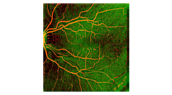 FIGURE 1. Angiographic OCT fundus image of human retina obtained by swept-source optical coherence tomography (SS-OCT) using a 1050 nm MEMS-VCSEL. Retinal vasculature (red) is superimposed on rich choroidal vessels (green background). Total image size is 12 &times; 12 mm, and no dye was injected to obtain the image.