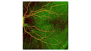 FIGURE 1. Angiographic OCT fundus image of human retina obtained by swept-source optical coherence tomography (SS-OCT) using a 1050 nm MEMS-VCSEL. Retinal vasculature (red) is superimposed on rich choroidal vessels (green background). Total image size is 12 &times; 12 mm, and no dye was injected to obtain the image.