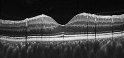FIGURE 2. Bioptigen's SDOIS C-series OCT system revealed a focal lesion in the outer photoreceptor segments of a patient who complained of unexplained vision distortions despite having only mild vision loss, or 20/30 vision. The system's findings, coupled with adaptive optics, pointed to commotio retinae—consistent with a past motor vehicle accident in which the patient had been involved. FIGURE 2. Bioptigen's SDOIS C-series OCT system revealed a focal lesion in the outer photoreceptor segments of a patient who complained of unexplained vision distortions despite having only mild vision loss, or 20/30 vision. The system's findings, coupled with adaptive optics, pointed to commotio retinae—consistent with a past motor vehicle accident in which the patient had been involved.