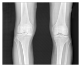 X-ray images, which are currently used to diagnose and monitor osteoarthritis, don&apos;t show cartilage loss, but fluorescence imaging allows direct viewing of disease progression&mdash;and thus promises earlier diagnosis and better treatment.