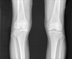 X-ray images, which are currently used to diagnose and monitor osteoarthritis, don't show cartilage loss, but fluorescence imaging allows direct viewing of disease progression—and thus promises earlier diagnosis and better treatment. X-ray images, which are currently used to diagnose and monitor osteoarthritis, don't show cartilage loss, but fluorescence imaging allows direct viewing of disease progression—and thus promises earlier diagnosis and better treatment.