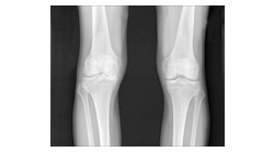 X-ray images, which are currently used to diagnose and monitor osteoarthritis, don&apos;t show cartilage loss, but fluorescence imaging allows direct viewing of disease progression&mdash;and thus promises earlier diagnosis and better treatment.