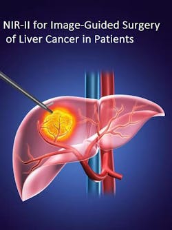 FIGURE 2. The principle of fluorescence-guided surgery is straightforward: label tissue of interest with a fluorescent agent, illuminate the area, and remove the glowing tissue. FIGURE 2. The principle of fluorescence-guided surgery is straightforward: label tissue of interest with a fluorescent agent, illuminate the area, and remove the glowing tissue.
