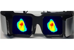FIGURE 4. Researchers are leveraging commercial developments to create effective ways of displaying fluorescence images to the surgeon, as in these goggles showing a representative tumor fluorescence. FIGURE 4. Researchers are leveraging commercial developments to create effective ways of displaying fluorescence images to the surgeon, as in these goggles showing a representative tumor fluorescence.