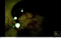 FIGURE 5. This still image from a video of resection surgery shows removal of pancreatic tumors from a mouse model. FIGURE 5. This still image from a video of resection surgery shows removal of pancreatic tumors from a mouse model.