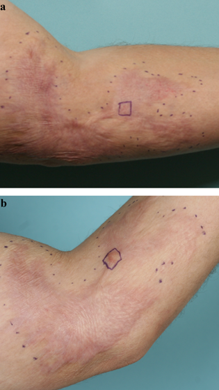 Mature Scars With Erythema Benefit From Fractional CO2 Laser Treatment ...